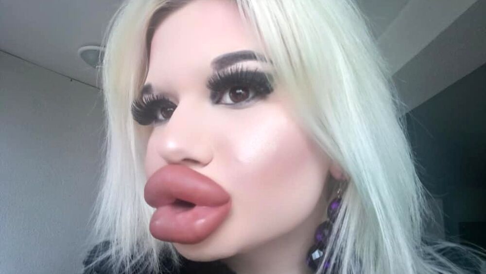 Après 20 fillers, à 22 ans, elle est la femme avec les plus grandes lèvres du monde
